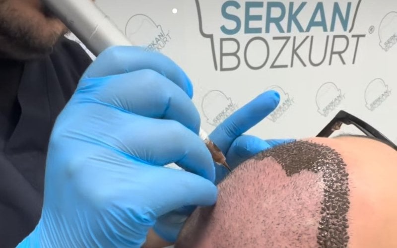 Saç Simülasyonu ( Saç Pigmentasyonu) ile Kellik Tarihe Karışıyor!